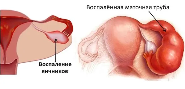 воспаление яичников картинка