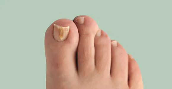 Грибок ногтей на ногах — средства для лечения. Средство от грибка ногтей на ногах отзывы. 38