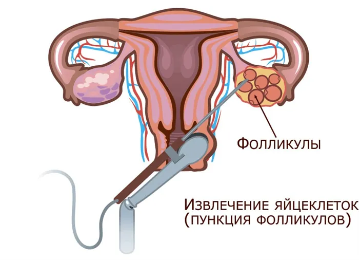 Получение яйцеклеток для проведения ЭКО